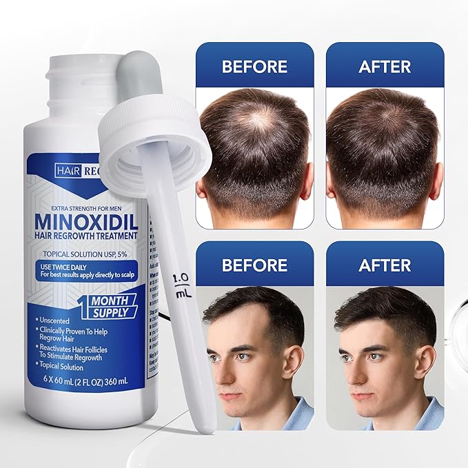Advanced 5% Minoxidil For Men Hair Regrowth Treatment for Thinning Hair - Hair Loss for Men - 1 Month Supply, Minoxidil Topical Solution So Thicker Fuller Hair Keeps Growing Amazing Results