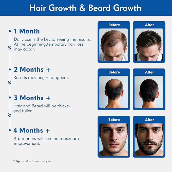 5% Minoxidil for Men, Extra Strength Hair Growth Serum, Beard Growth Oil, Fast Absorbing Dropper, Non Greasy, Low Residue Formula, 2-Pack for 2 Months, Hair Regrowth Treatment for Thinning Hair