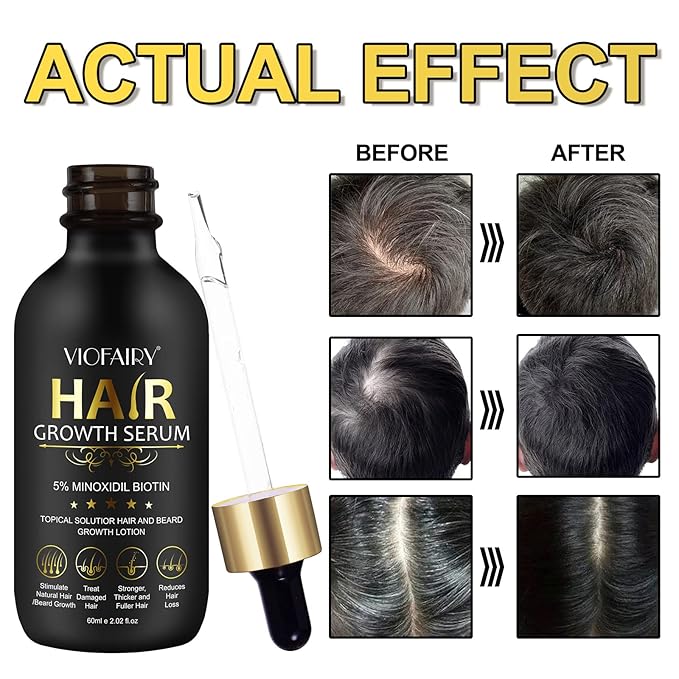 5% Minoxidil for Men and Women Hair Growth Serum, Hair Growth for Men Kit with Minoxidil 5% & Biotin Hair Regrowth Treatment, Natural Hair Growth for Thicker Longer Fuller Healthier Hair 2.02oz